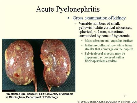 pyelonephritis causes symptoms treatment pyelonephritis