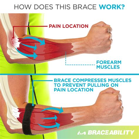 epicondylitis brace elbow strap  medial lateral epicondyle pain
