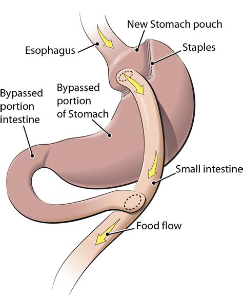 requirements    gastric bypass surgery