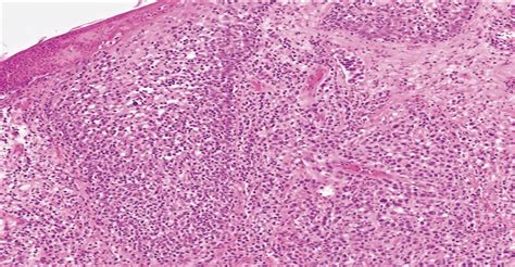 primary cutaneous anaplastic large cell lymphoma  p