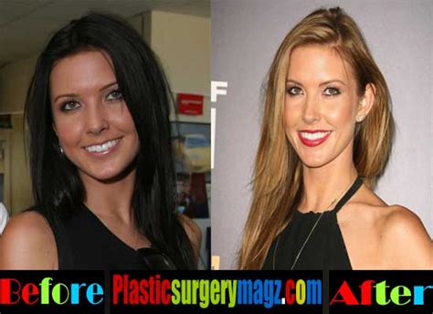 Audrina Patridge Plastic Surgery Before And After Photos