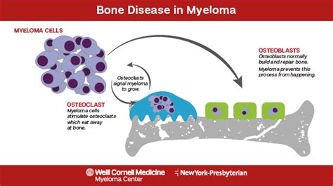 myeloma signs  symptoms myeloma center