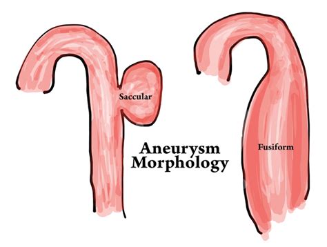 emdocsnet emergency medicine educationthoracic aortic aneurysms