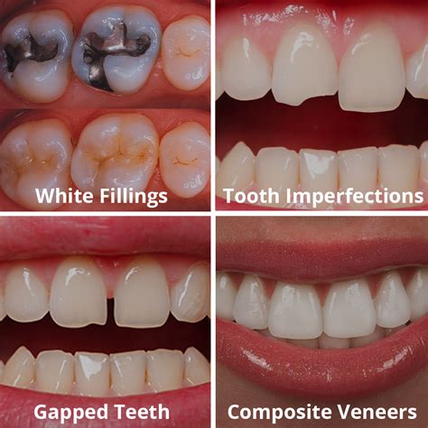 dental bonding gentle dentistry