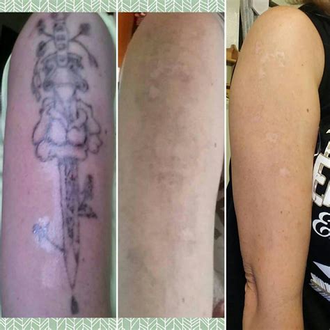 tattoo removal techniques dallasplanofriscoaddison