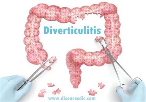 diverticulitis symptoms treatment and types of surgery