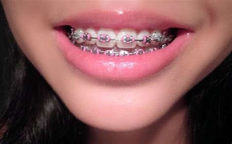 pin by evil h on beautiful braces braces colors dental braces teeth