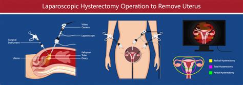 Laparoscopic Assisted Vaginal Hysterectomy North Texas Medical Center