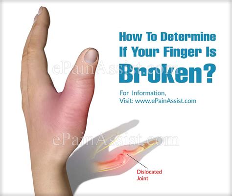 how to determine if your finger is broken and ways to manage a broken finger