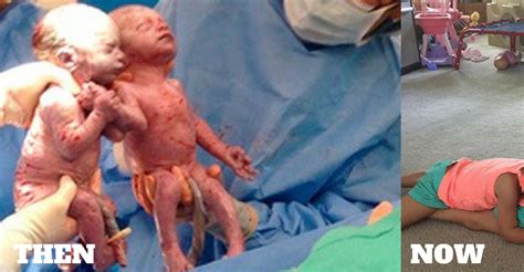 These Rare Twins Were Born Holding Hands See What They Look Like Now
