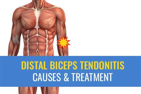 Distal Biceps Tendonitis – Causes And Treatment