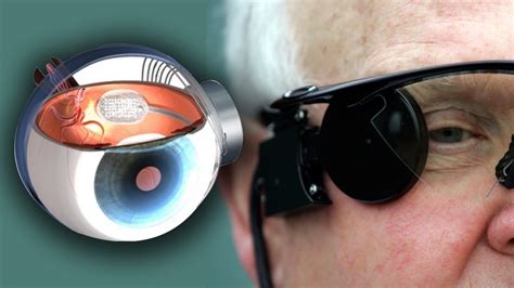 bionic eye cures blindness youtube