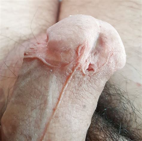 Strange Penis Head 3 Pics Xhamster