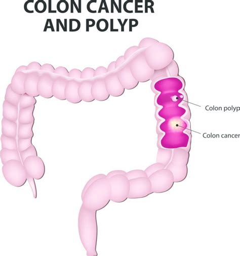colon cancer symptoms causes treatment and diagnosis