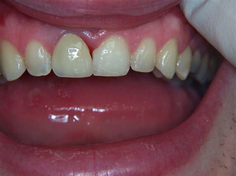 gingivitis   dentist