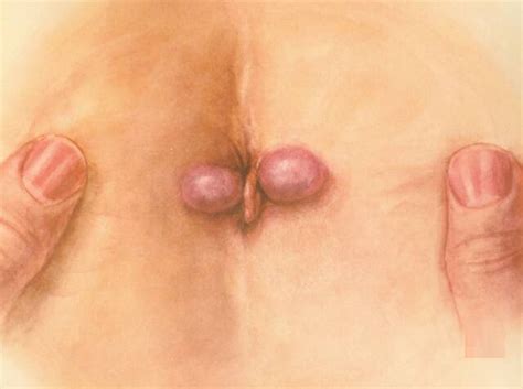 Anal sex hemmoroids