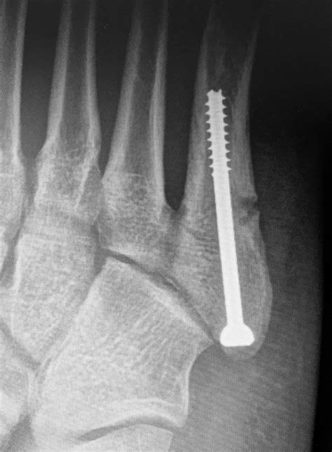 X Ray Of One Players Fifth Metatarsal Stress Fracture Insidious