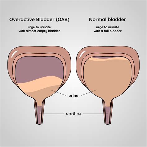 Overactive Bladder Doesnt Have To Control Your Life Ms Urology