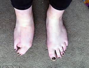 rare form of gigantism leaves matilda carnegie with two toes on her