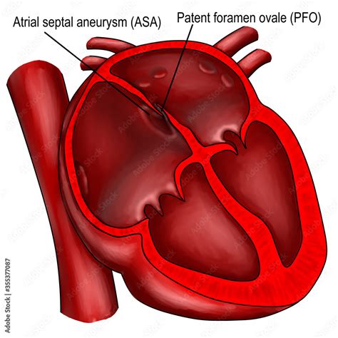 patent foramen ovale  atrial septal aneurysm   structural