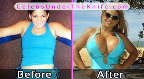 9 bad breast implants gone wrong before and after photos