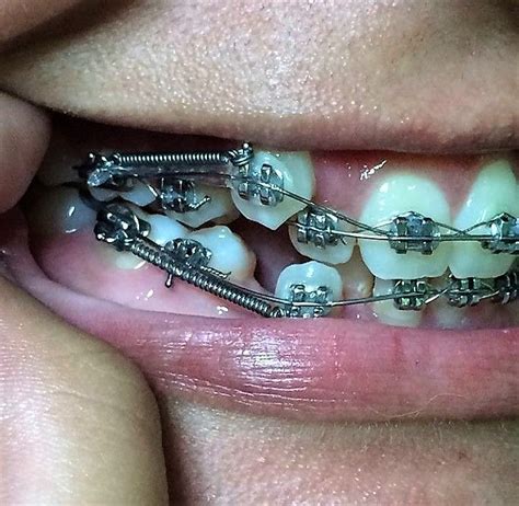pin on orthodontic braces