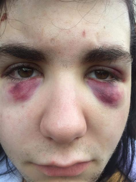 teenager beaten up in homophobic bus attack says i won