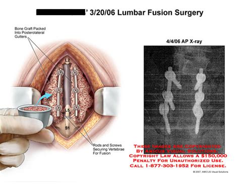 Amicus Illustration Of Amicus Surgery Lumbar Fusion Graft