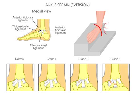 ankle strains top ten sporting injuries