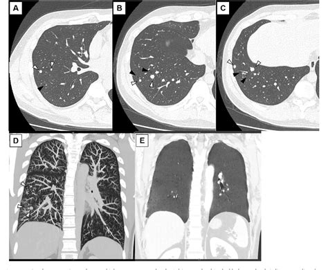 Figure 1 From A Case Of Multiple Lung Carcinoid Tumors Localized In The