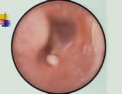 Growth ear canal