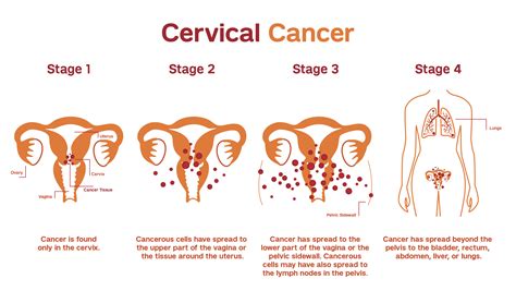 cervical cancer patient care