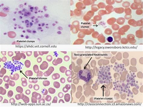 haematology   nutshell platelet clumps