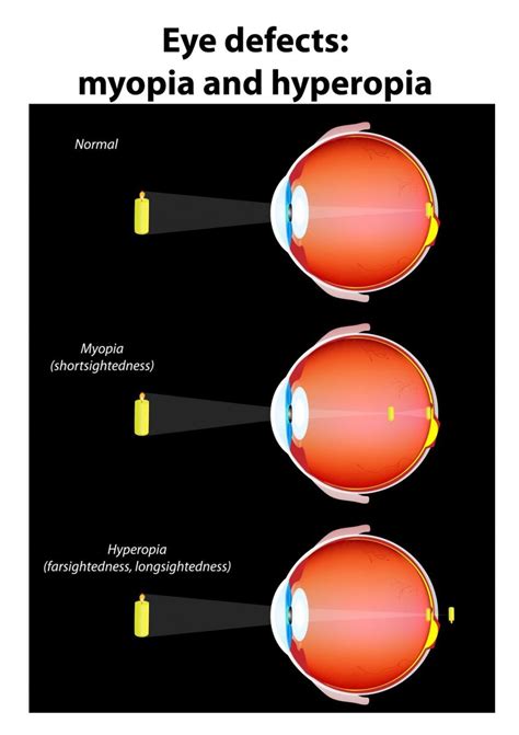 hyperopia singapore what is farsightedness genetic