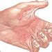 contracture deformity symptoms  tests ny times health information