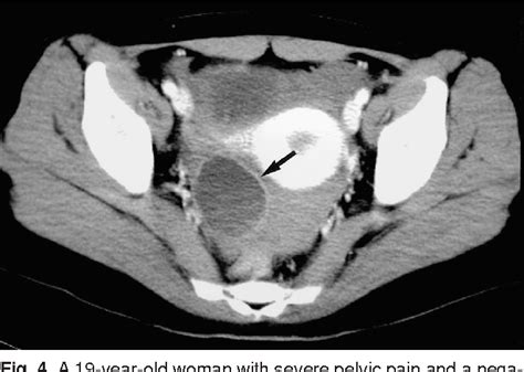 figure 4 from ruptured corpus luteal cyst ct findings semantic scholar