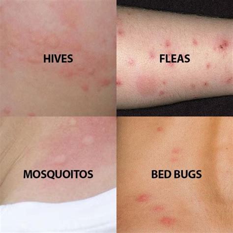 image    bitesskin conditions   bed bug