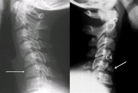 interpretations of the c spine on plain radiography