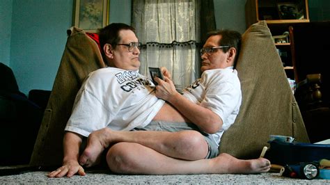 ronnie  donnie galyon worlds longest surviving conjoined twins die