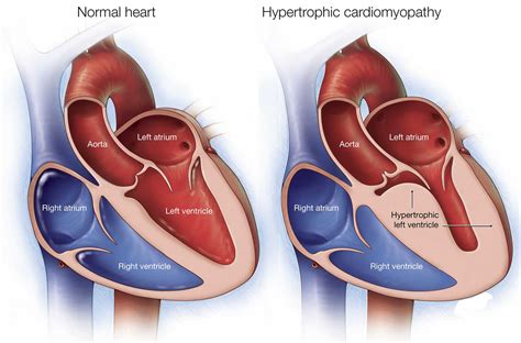 asymmetric septal hypertrophy definition  symptoms diagnosis