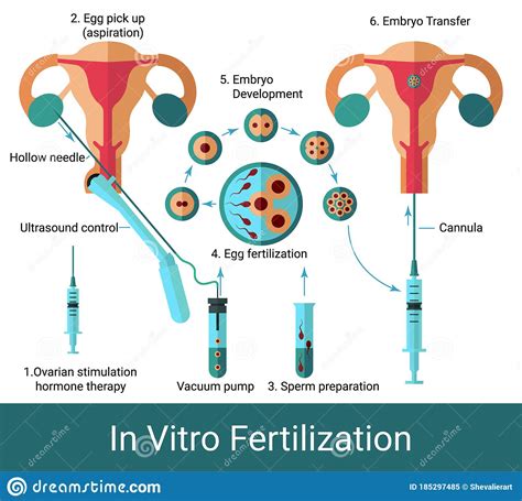 in vitro fertilization infographic chart stock vector illustration