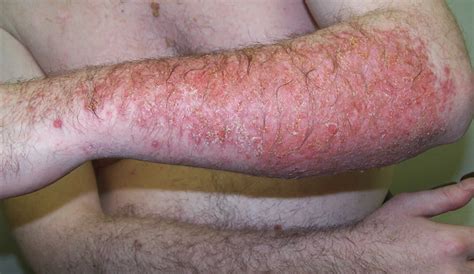 allergic contact dermatitis  symptoms diagnosis treatment