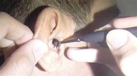 mans massive ear wax extraction youtube