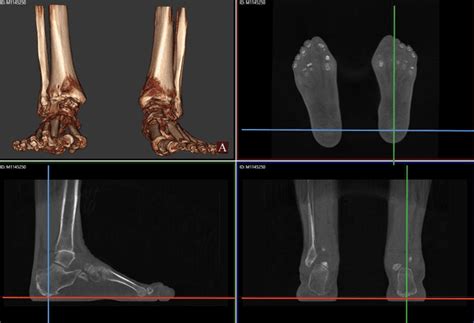 comparison   hindfoot alignment measurements radiographic