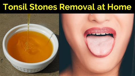 cure tonsillitis permanently tonsil stones removal  home