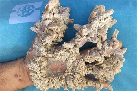 Palestinian Cured From ‘tree Man Disease’ That Gave Him Branch Like