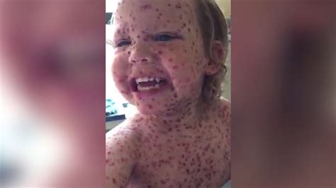 cambridgeshire mum calling for free chickenpox vaccine itv news anglia