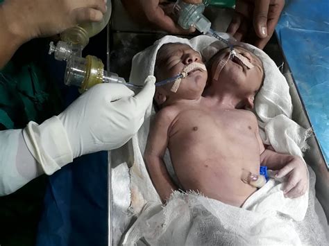 Conjoined Twins Born With Two Heads And One Body Die In Hospital Just