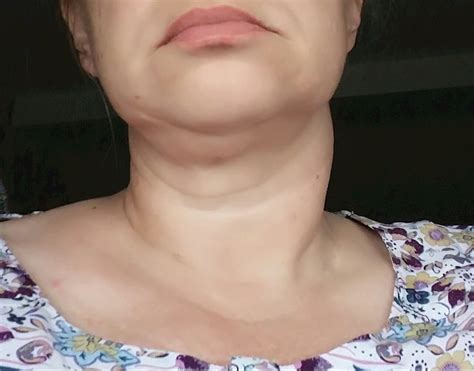 swollen neck and thyroid nodule thyroid uk healthunlocked
