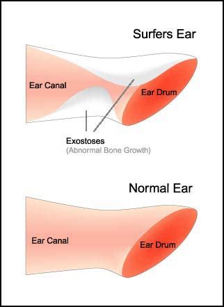 Growth ear canal